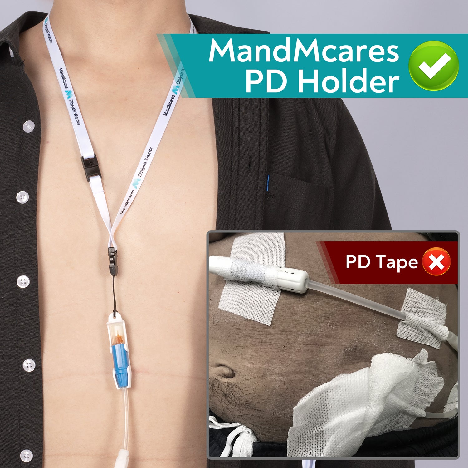 Small PD Transfer Set Holder  (1 Holder & 2 Adjustable Lanyards)